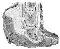 LONGITUDINAL SECTION OF A FOOT WITH LAMINITIS OF SEVERAL YEARS' DURATION.