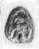 FRACTURE OF THE PYRAMIDAL PROCESS IN BUTTRESS FOOT.