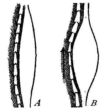 Fig. 29—Diagram to show how the muscles pump lymph. A. Relaxed muscle beside which is a lymphatic tube. B. Same muscle in state of contraction. Fig. 29