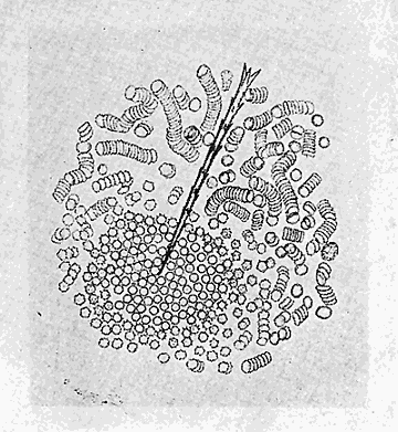 37. (b) Effect of the poison on the blood corpuscles of man. After Tyzzer.