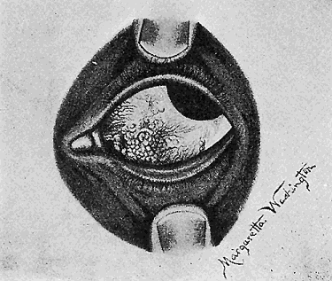41. (a) Nodular conjunctivitis in the eye of a child. De Schweinitz and Shumway.