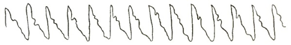 Aortic Regurgitation